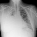mesothelioma